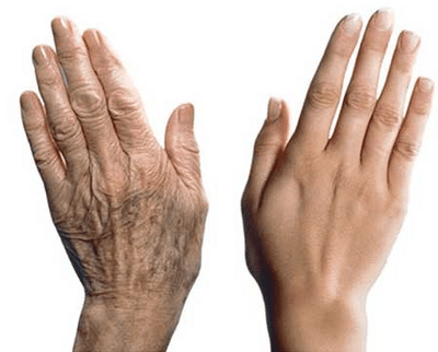 Signs of the Aging Hands: brown spot prevention