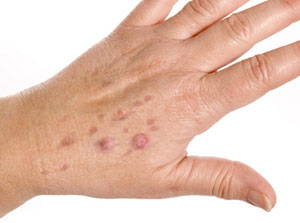 Squamous Cell Skin Cancer on the Hands