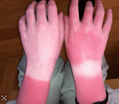 Golfers’ Left Hand vs Right Hand and Sun Protection Tips