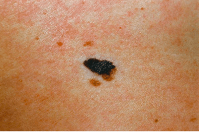 Will my moles turn into melanoma?