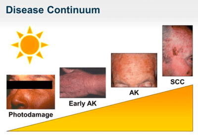 What are actinic keratosis? (plural actinic keratoses)