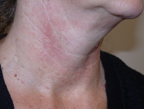 Signs of an Aging Neck: How to Prevent and Improve the Aging Neck